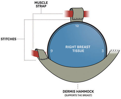 breast-surgery-diagram