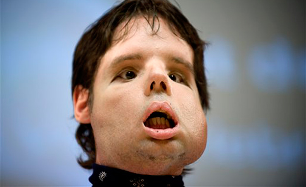 Recipient of First Ever Full FACE TRANSPLANT Appears in Public for ...