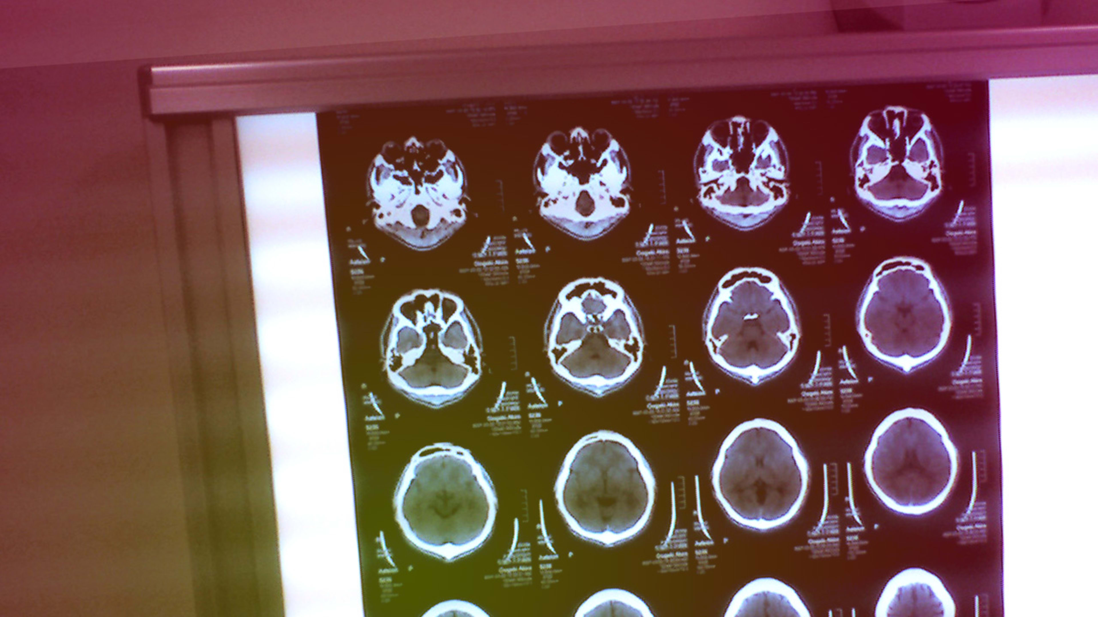 How The Global Hive Mind Is Teaming Up To Find A Cure For Alzheimer’s