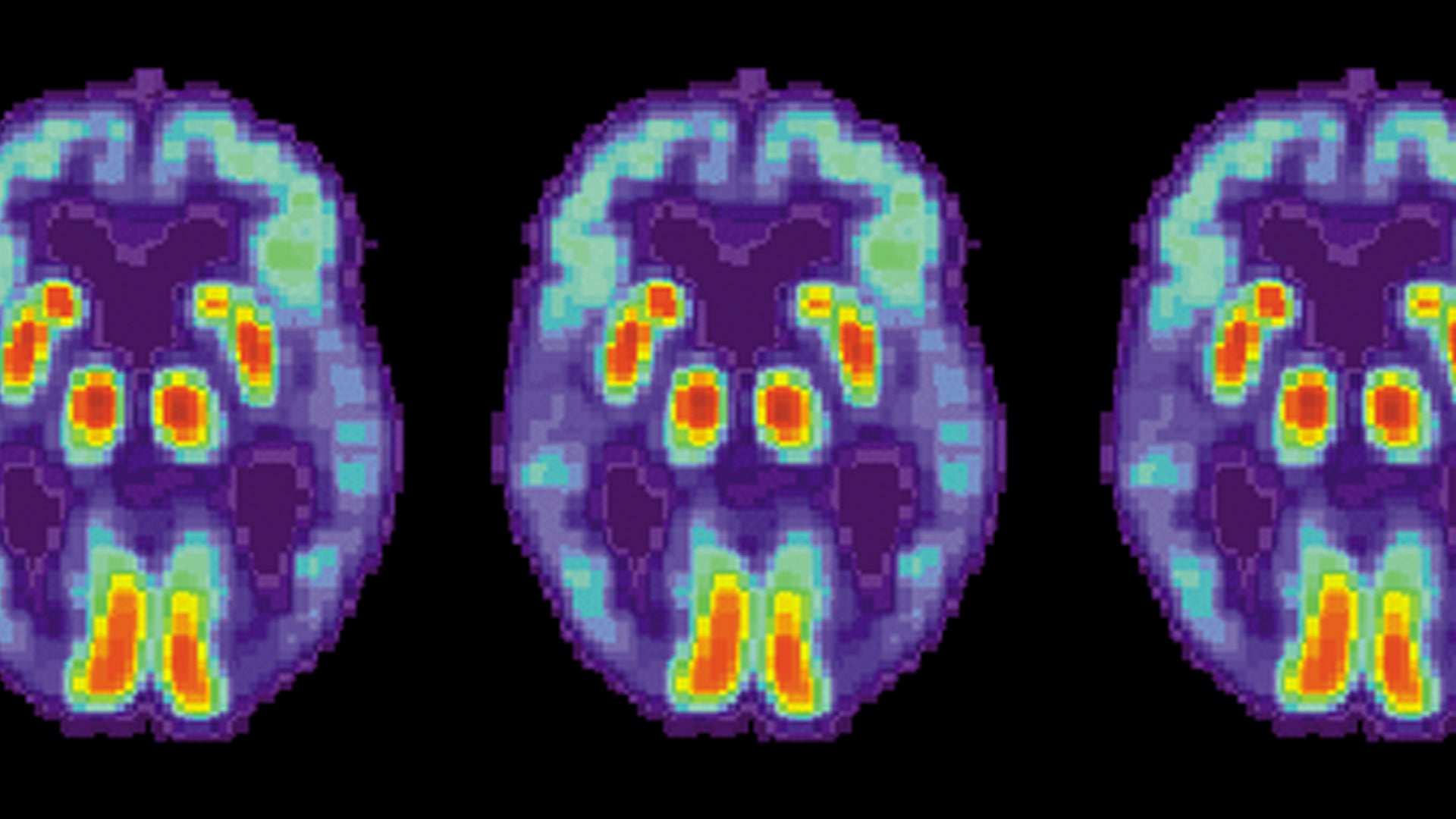 Artificial intelligence can detect Alzheimer's in brain scans six years ...