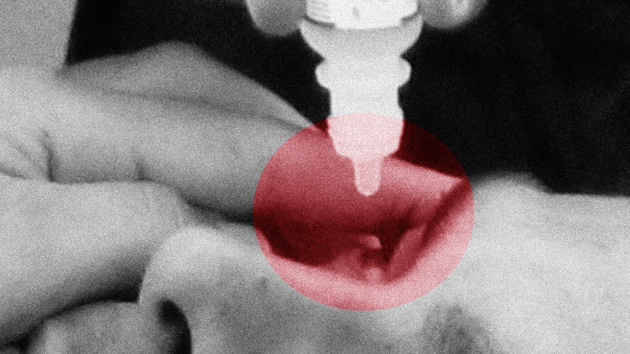 Serious eyedrop recall hits CVS, Walgreens, Walmart Here's what to