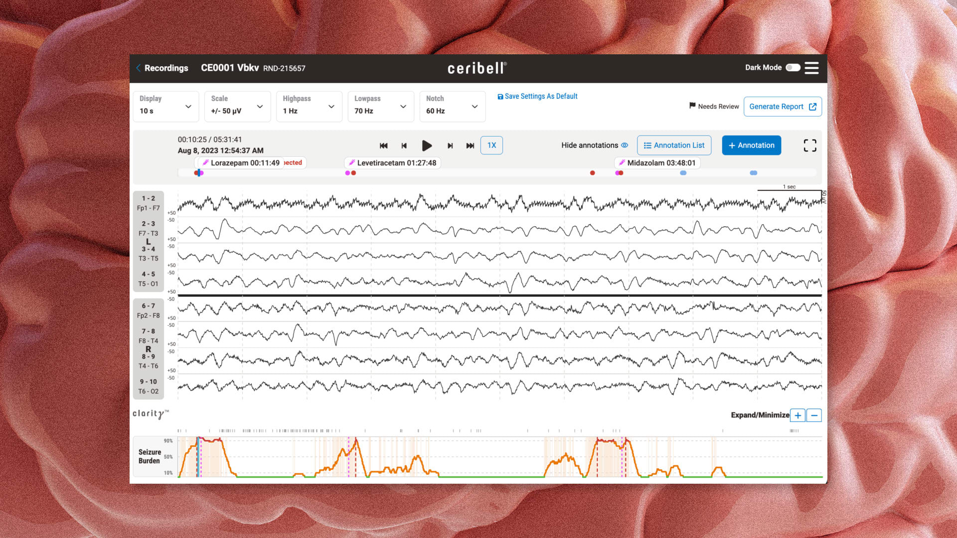 CeriBell IPO: Stock price soars as AI brain-monitoring headband maker debuts on Nasdaq