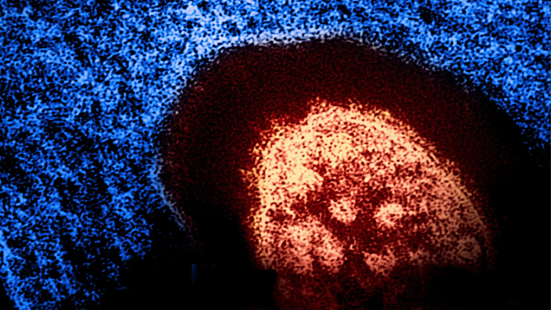 The U.S. eliminated measles 26 years ago. Now it could lose that status in ...