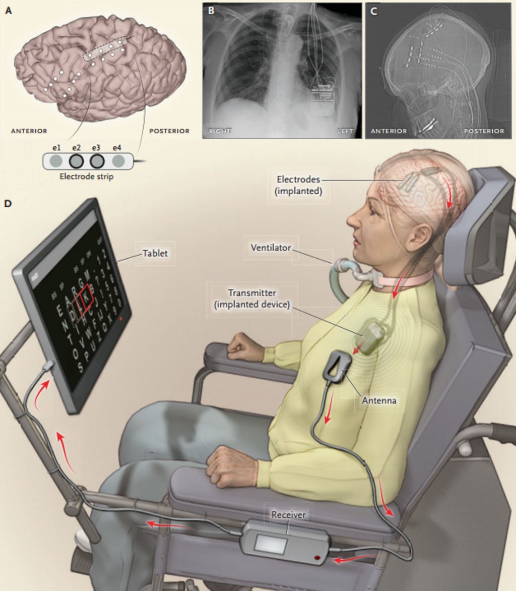 Paralyzed woman becomes first patient to use a brain-computer at home ...