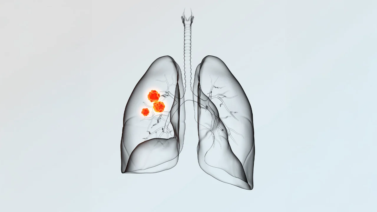 New AI outlines lung tumors better and faster than doctors, study finds