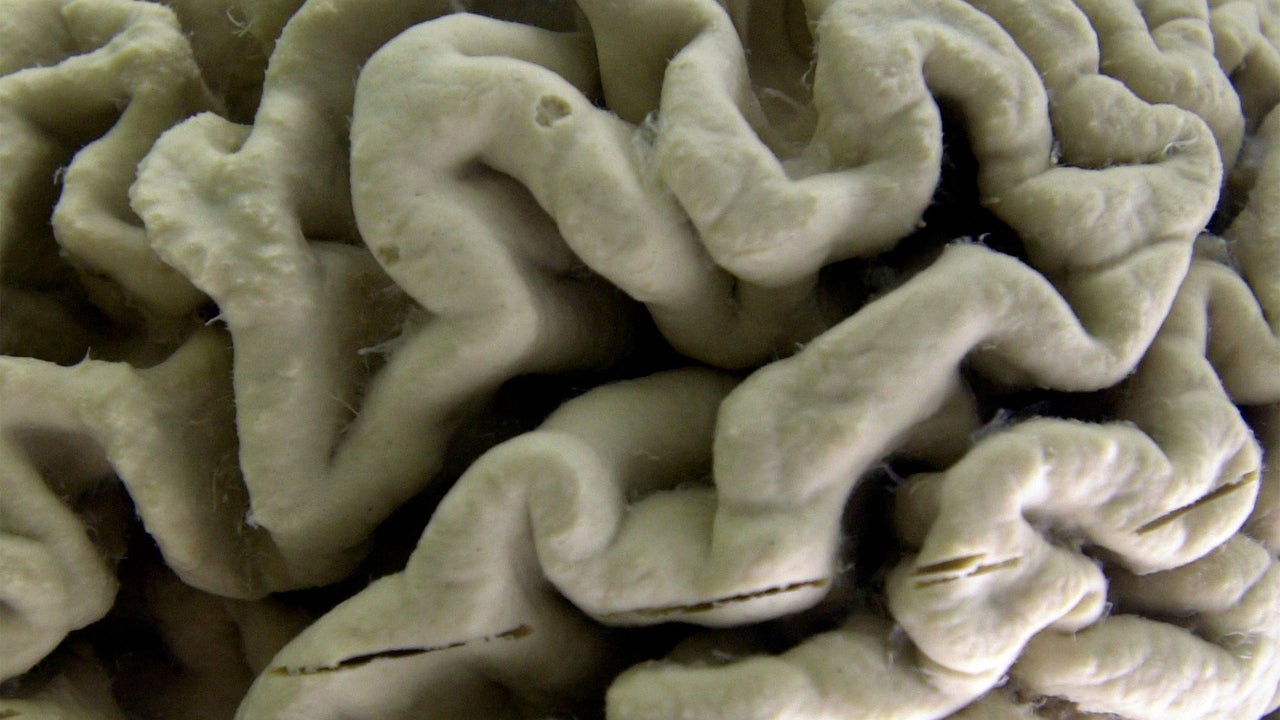 Blood Test May Predict Alzheimer's Risk in Healthy Adults