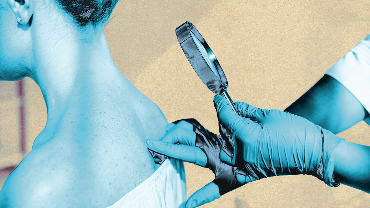 AI Skin Cancer Tools Show Bias Against Darker Skin Tones
