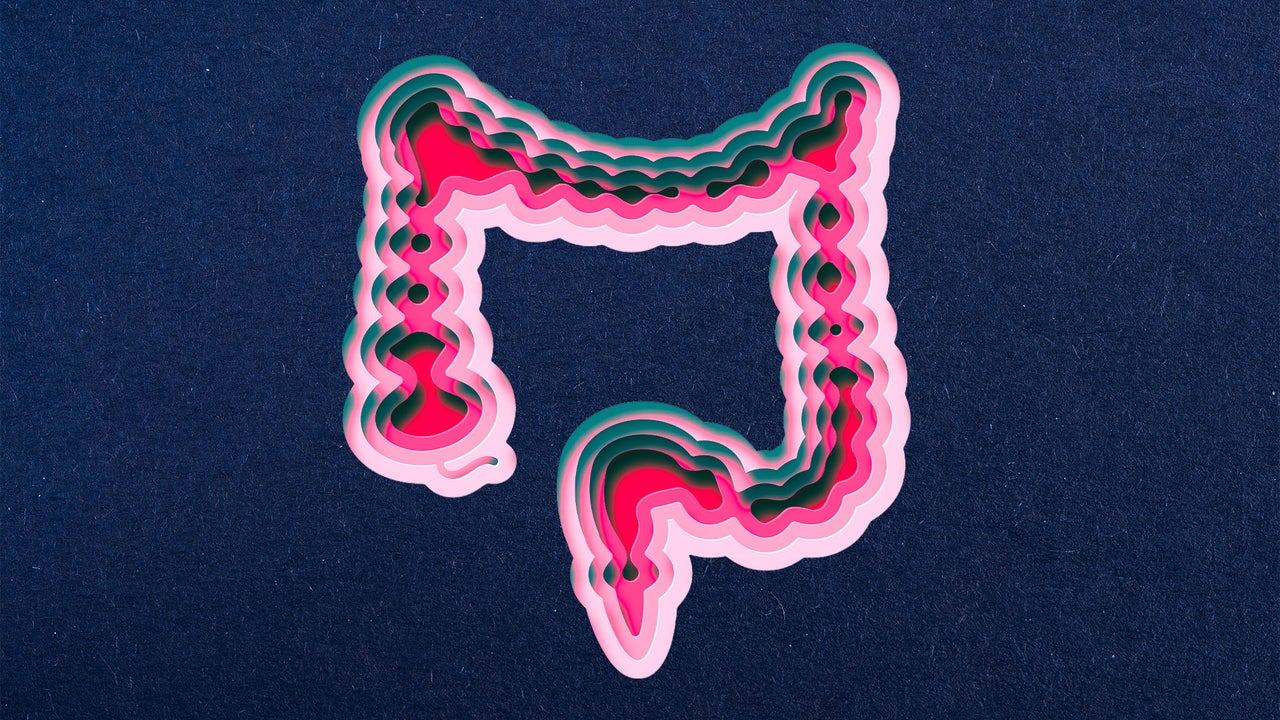 Colon cancer rates are rising for the first time in 20 years. Here’s who’s most at risk