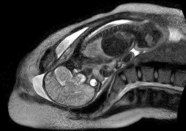 MRI scan of baby being born