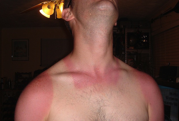 sunburn