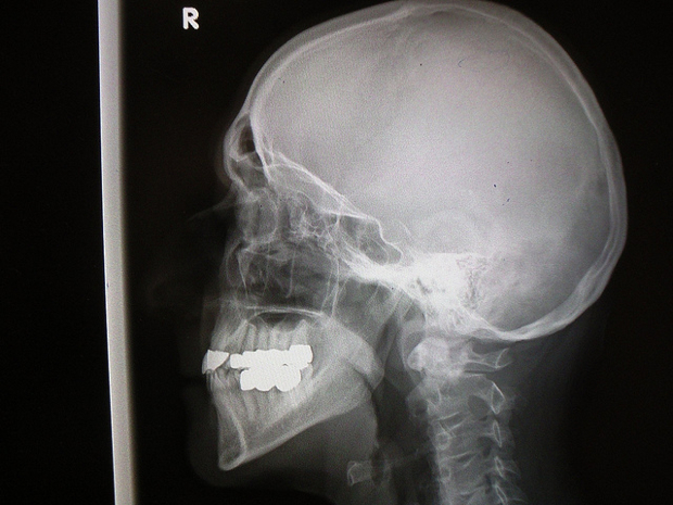 skull X-ray